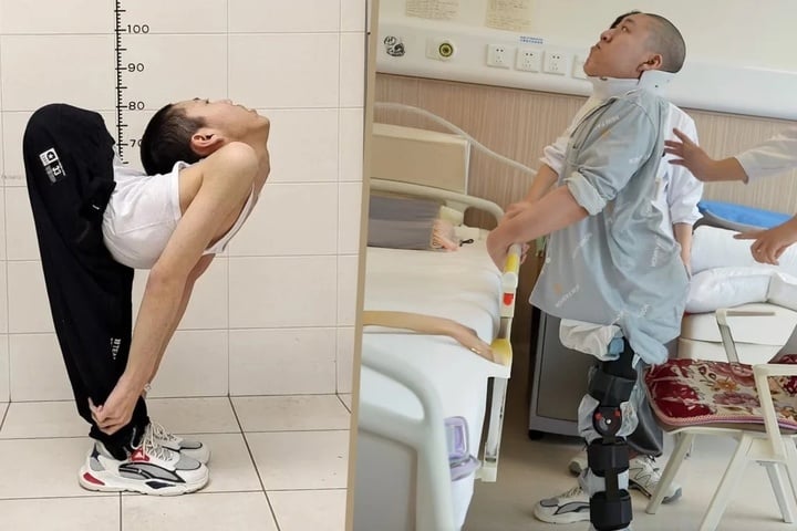Chàng trai vượt qua cột sống cong hình chữ Z lần đầu đứng thẳng sau nhiều ca phẫu thuật - Ảnh 2.